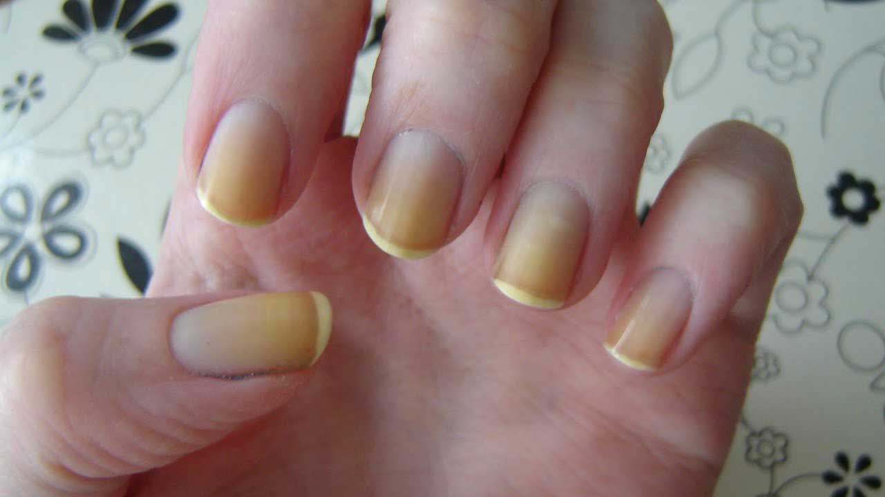 Why do nails turn yellow?